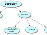 Ectropion Concept Map