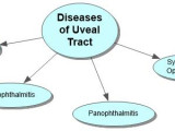 Diseases of Uveal Tract Concept Map