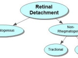 Retinal Detachment Concept Map