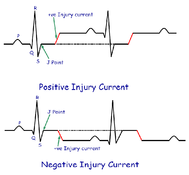 Current Of Injury In ECG HowMed