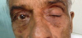 Protocol of Examination of Ptosis