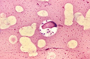 Leishmania donovani in bone marrow