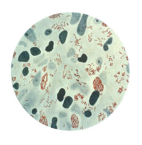 Mycobacterium leprae, small brick red rods