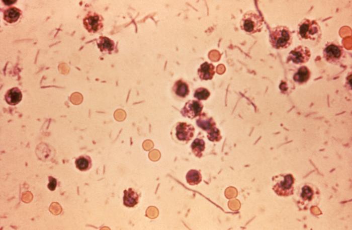 Photomicrograph of Shigella in stool sample