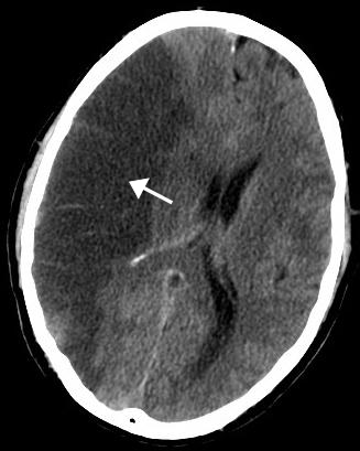 cerebral ischemia