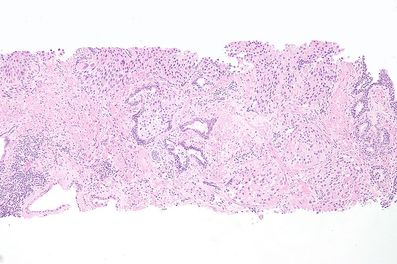 exophytic papilloma of bladder