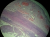 acute-appenticitis