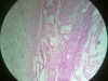 acute-inflammation-1