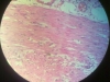 acute-inflammation-2