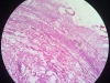 acute-inflammation-5