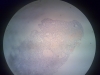 amyloidosis-2
