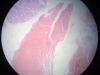 amyloidosis-3