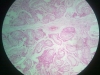 atrophy-3