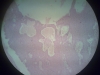 basal-cell-carcinoma