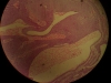 basal-cell-carcinoma-10x