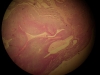 basal-cell-carcinoma-4x