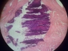 calcification-8-thyroid