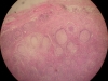 chronic-granulomatous-inflammation-4x