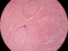 chronic-granulomatous-inflammation-10x