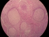 chronic-granulomatous-inflammation-10x