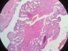 chronic-inflammation-2