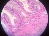 chronic-inflammation-5