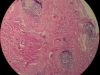 chronic-inflammation-10x