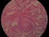 chronic-inflammation-40x