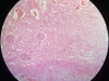 coagulative necrosis-kidney