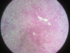 liver-congestion