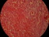 lungs-congestion