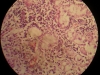 lungs-congestion