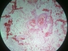 lungs-congestion
