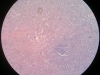 spleen-congestion-1