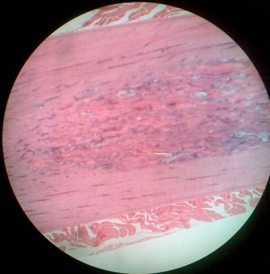 Dense irregular connective tissue
