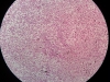 fatty liver-10x