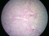 fatty liver