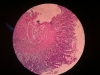 Chronic gastritis 10x
