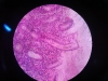 Chronic gastritis-40x