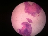 Chronic gastritis-4x