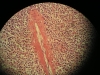 hemosiderosis-1