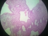 hyperplasia-3