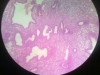 hyperplasia-4