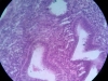 hyperplasia-6