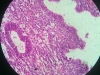 hyperplasia-8