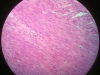 leiomyoma-1