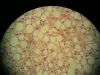 lipoma-1