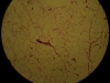 lipoma-2-10x