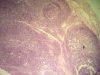 Palatine Tonsils