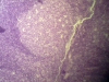 Pharyngeal Tonsils